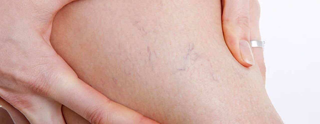 how varicose veins